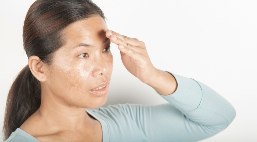 Hạn chế sạm, nám, tàn nhang